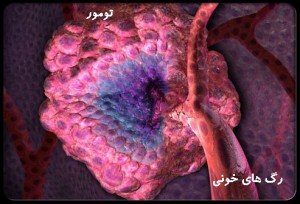 ovarian-cancer-s13-photo-of-ovarian-tumor